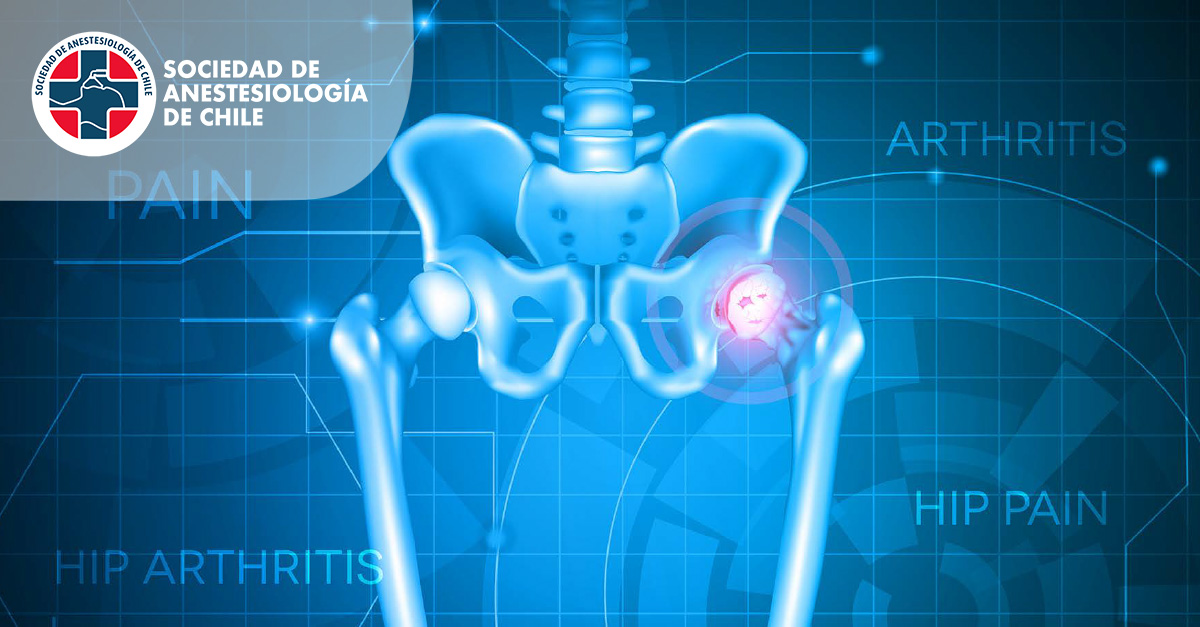 CP2: Anestesia/analgesia para cirugía de Cadera